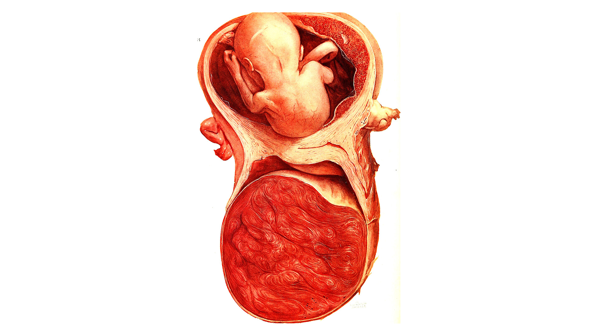 Gestational Trophoblastic Disease StoryMD