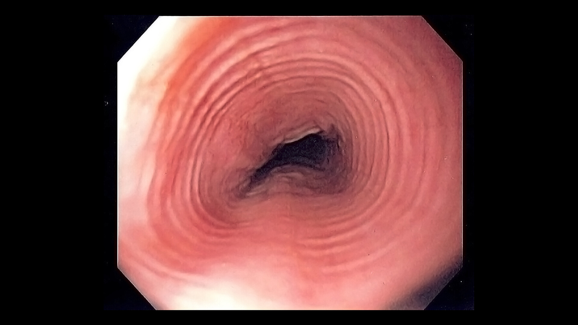 What Is Eosinophilic Esophagitis Eoe Storymd