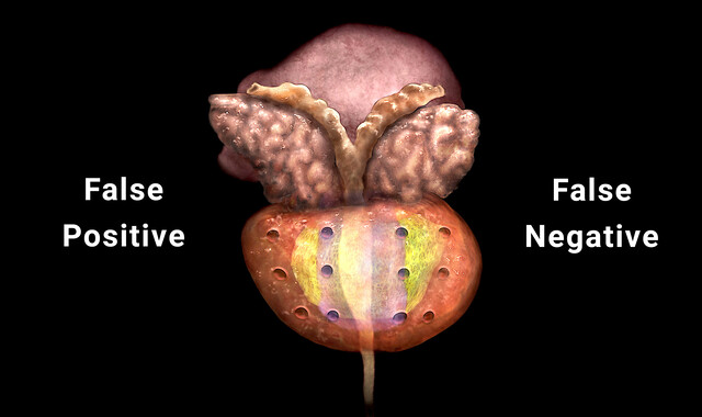 The Importance Of Cancer Screening StoryMD