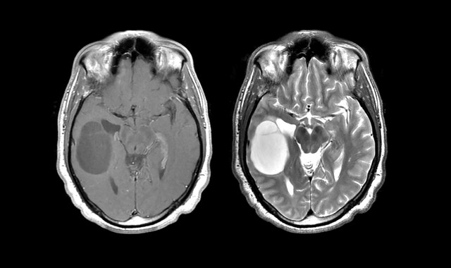 Gadolinium Based Contrast Agents GBCAs StoryMD