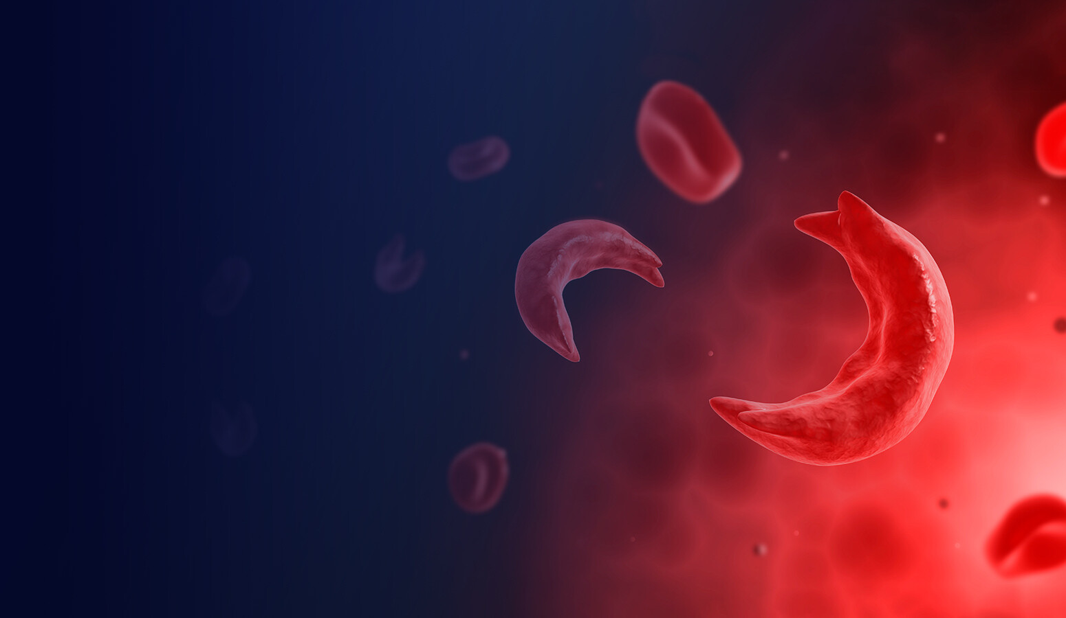 Gene Therapy For Sickle Cell Disease StoryMD