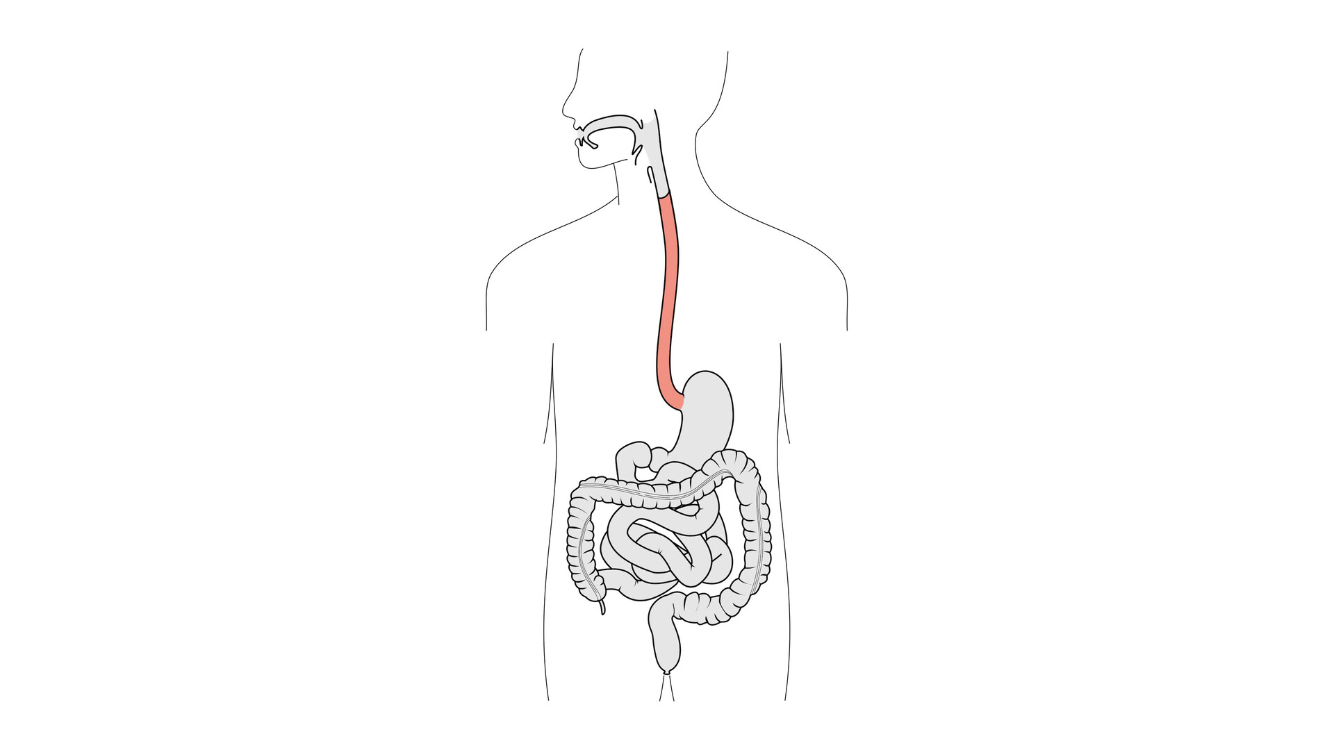 Esophagus Disorders Storymd