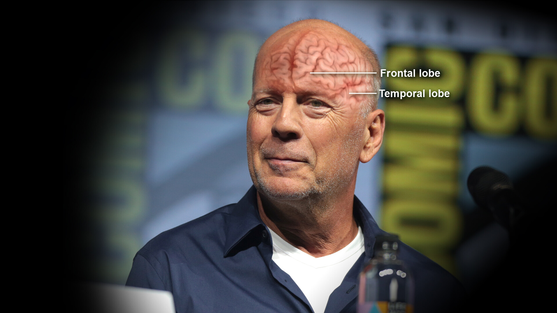 Bruce Willis Frontotemporal Dementia Explained StoryMD