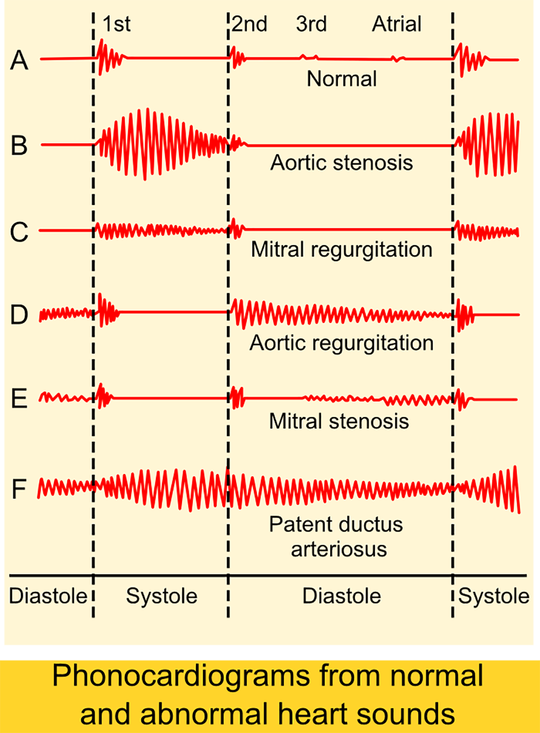 What Are The Signs And Symptoms Of Patent Ductus Arteriosus Storymd