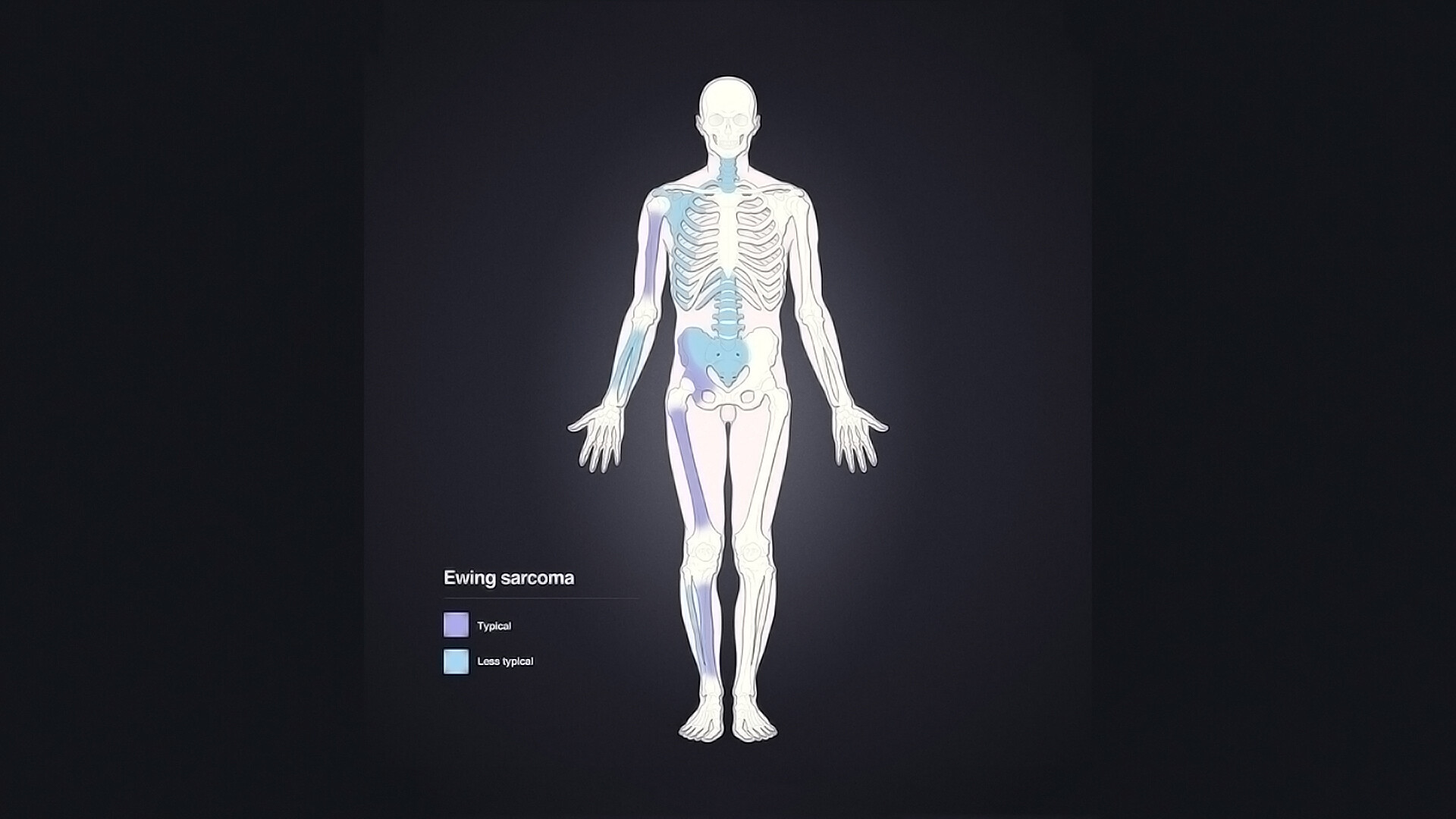 What Are The Different Types Of Primary Bone Cancer Storymd