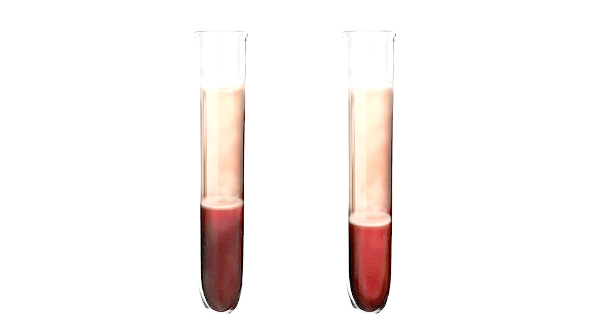 Congenital Dyserythropoietic Anemia Storymd