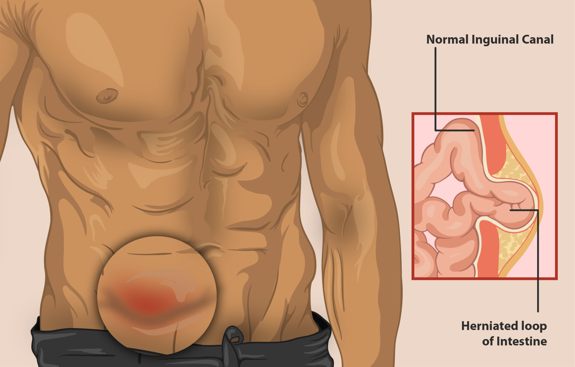 Pulled Groin vs Hernia, What Can be Mistaken for a Hernia?