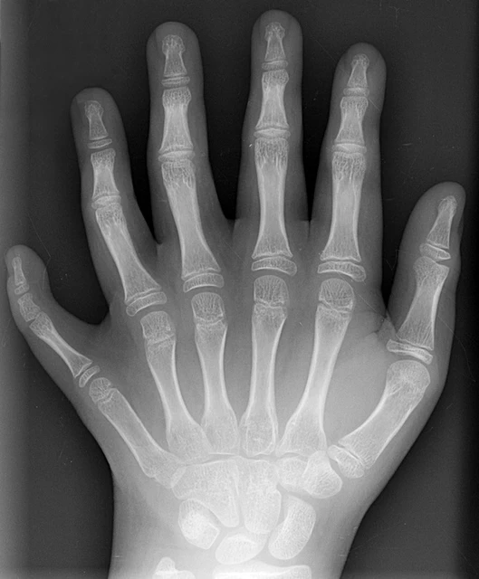 Apert Syndrome Mitten Hand