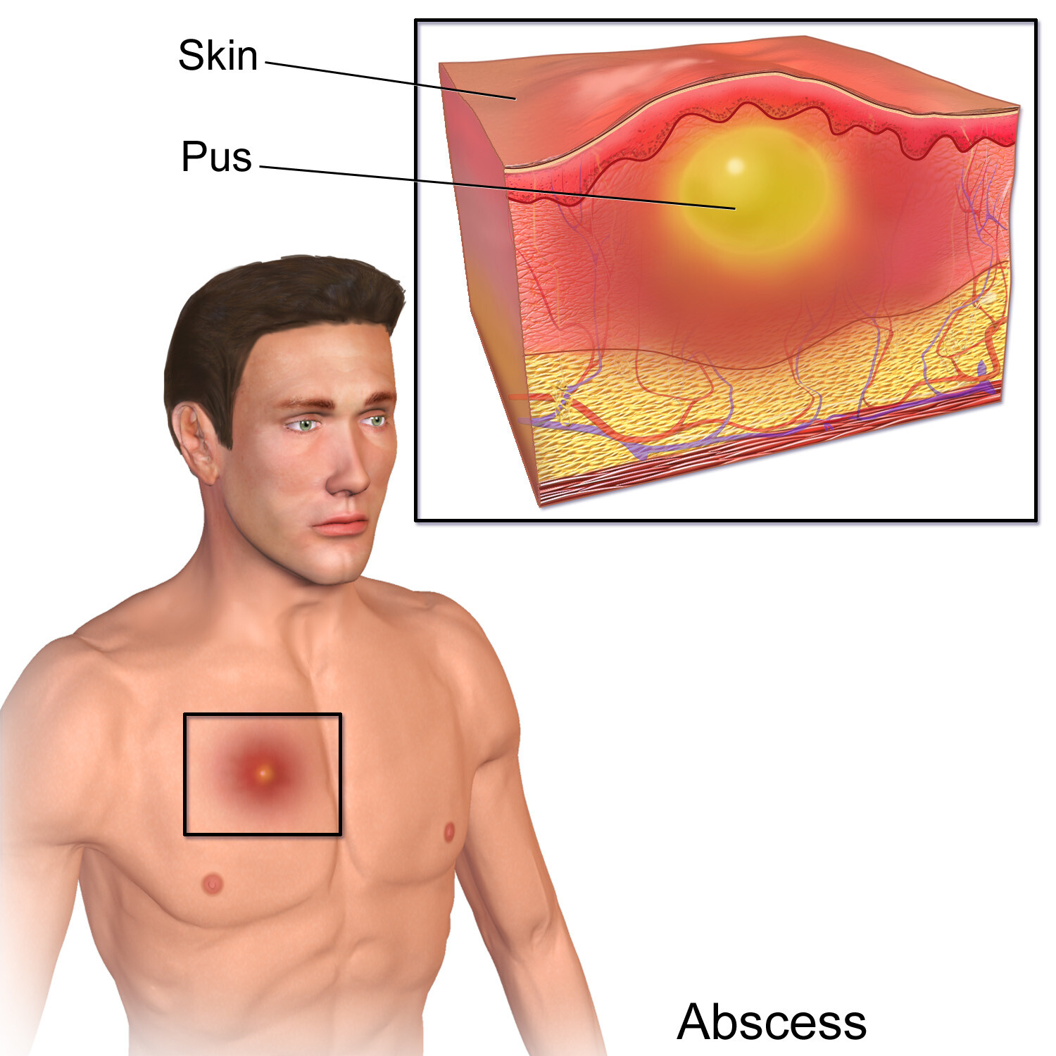 Staphylococcal Infections - StoryMD