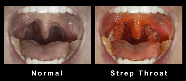 normal throat vs strep throat