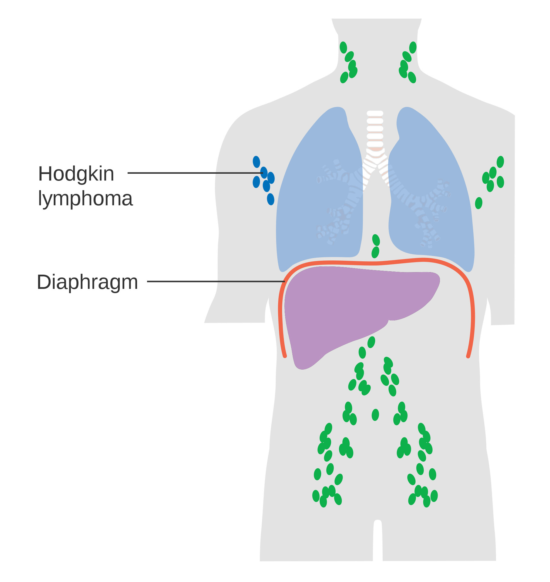 Stages Of Adult Hodgkin Lymphoma Storymd 