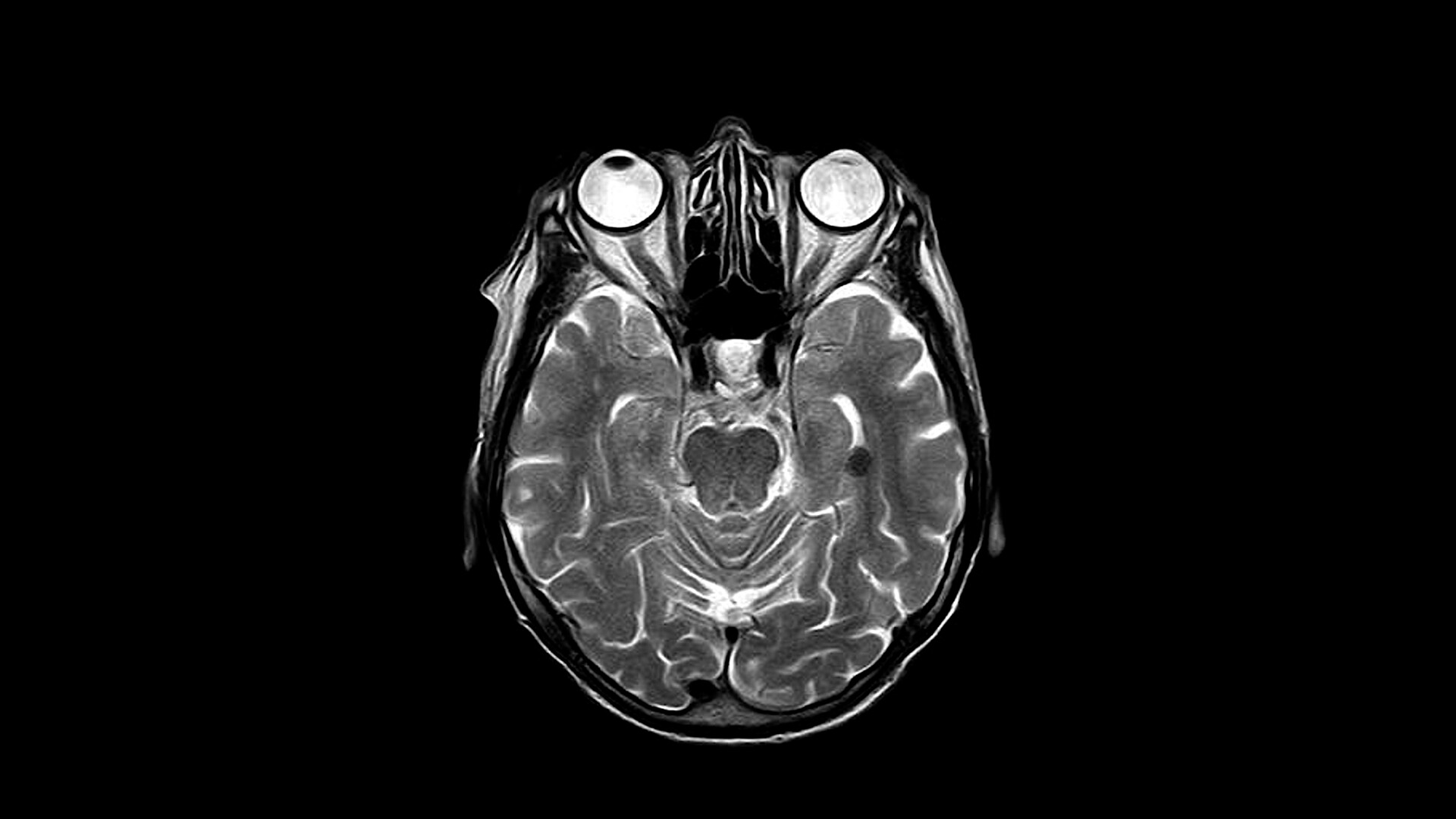 Magnetic Resonance Imaging Mri Scans Storymd 