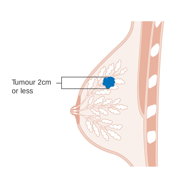 Breast Cancer Staging Examples - StoryMD