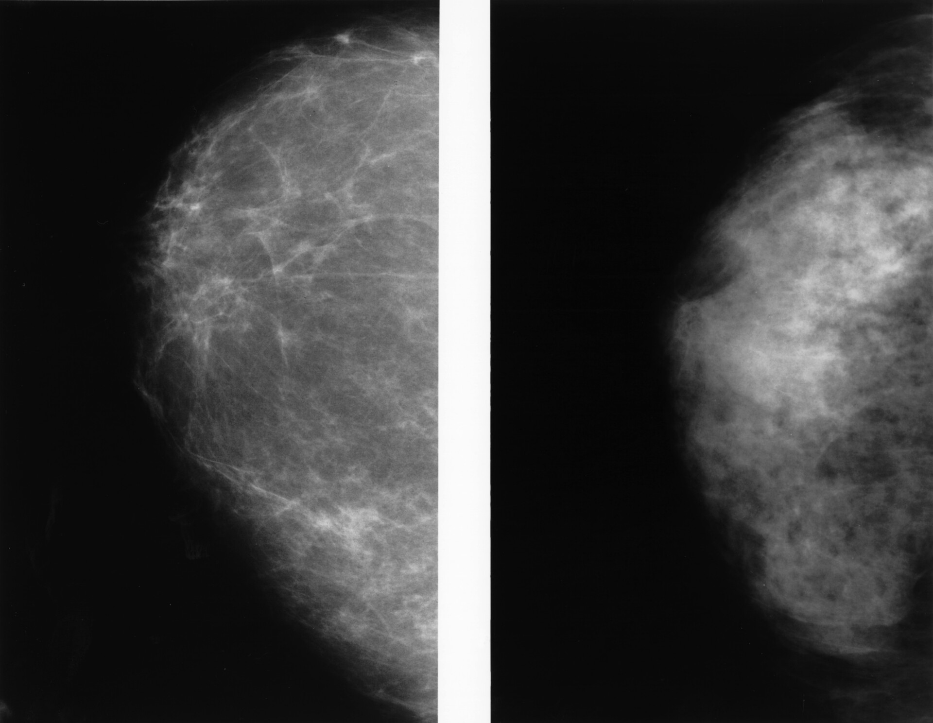 Dense Breasts: Answers to Commonly Asked Questions - StoryMD