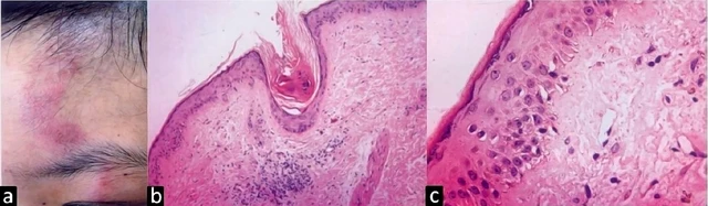 Lupusの魔法の館　0714 Systemic Lupus Erythematosus (SLE) - Medical-Surgical (Immune‬