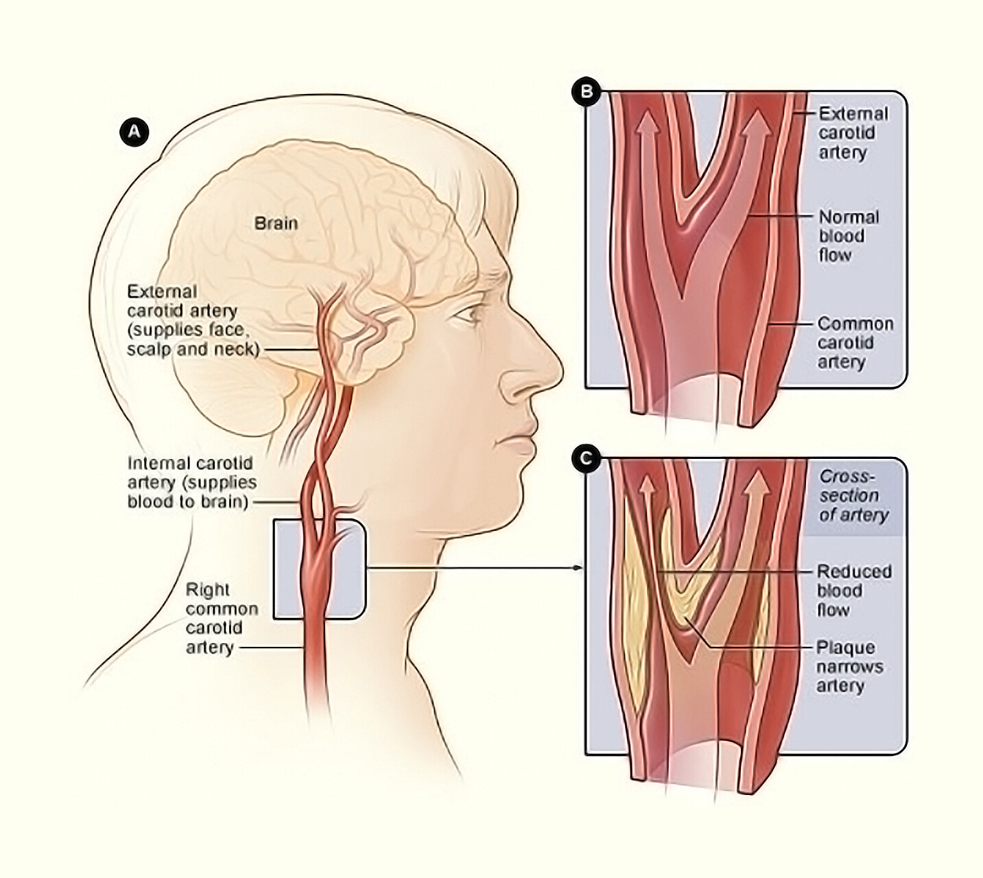 Где находится сонная артерия слева. Сужение сосудов головного мозга. Общая Сонная артерия. Стеноз внутренней сонной артерии.