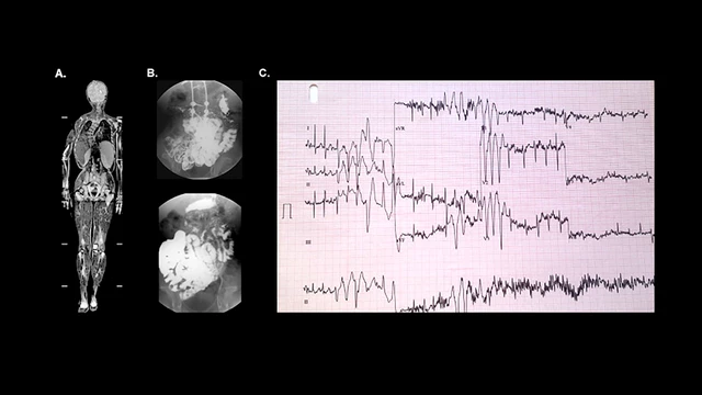 Related Content - Barraquer-Simons Syndrome - StoryMD