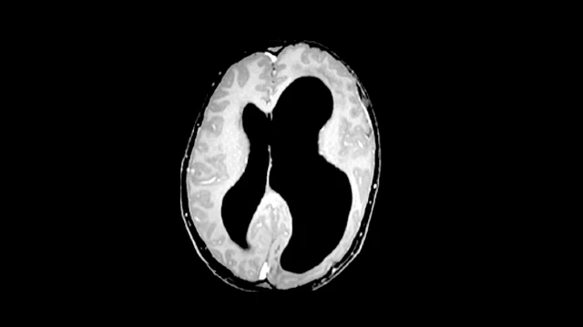 Megalencephaly Capillary Malformation