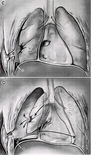 Thoracentesis - StoryMD