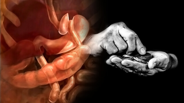Cost of Weight-Loss Surgery