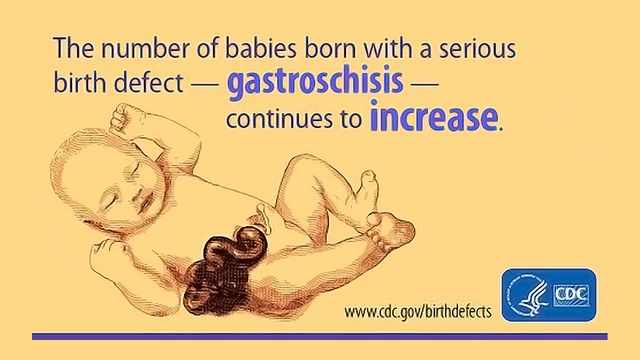 Gastroschisis Prognosis