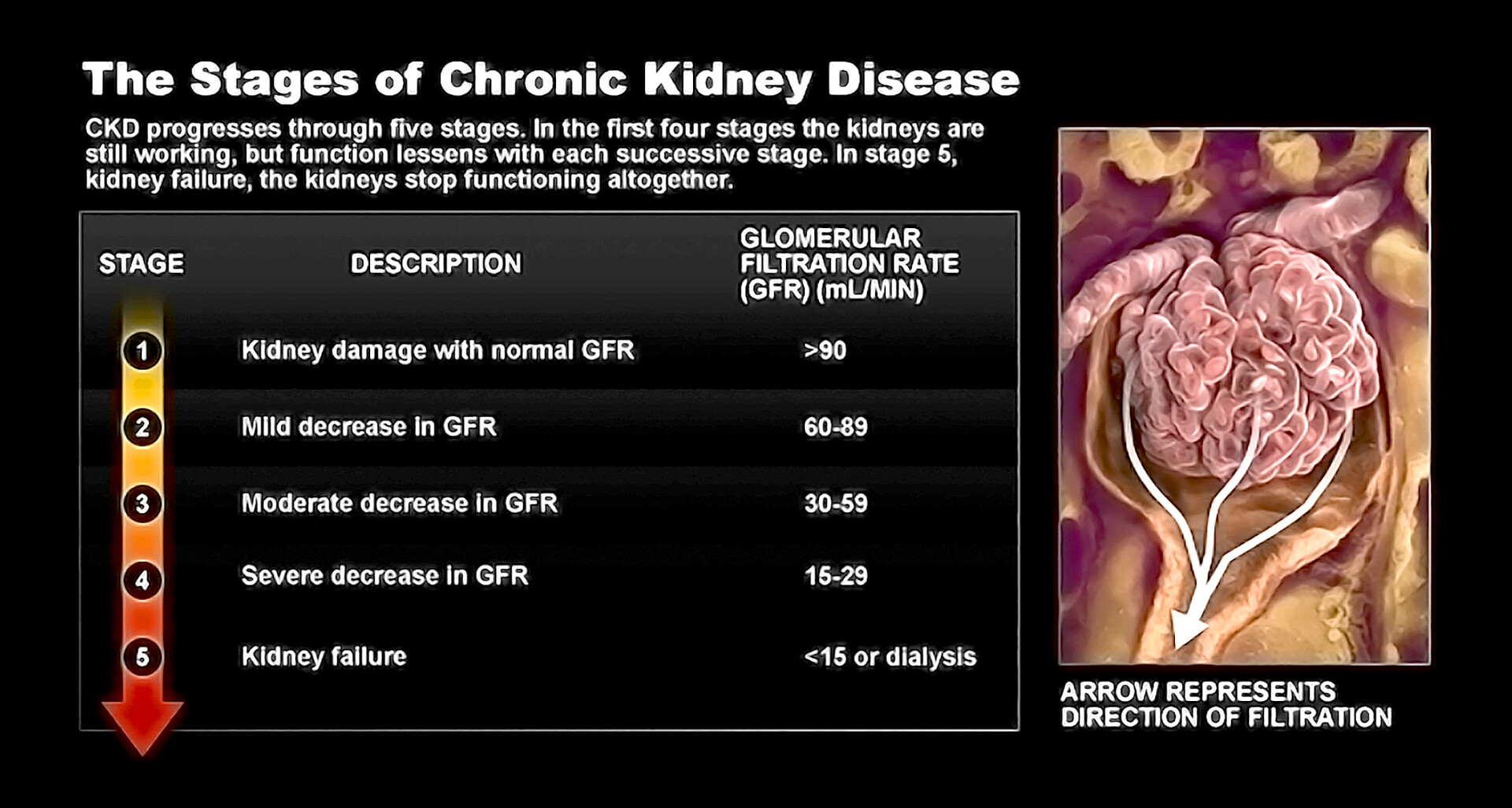 g5 15 kidney failure meaning