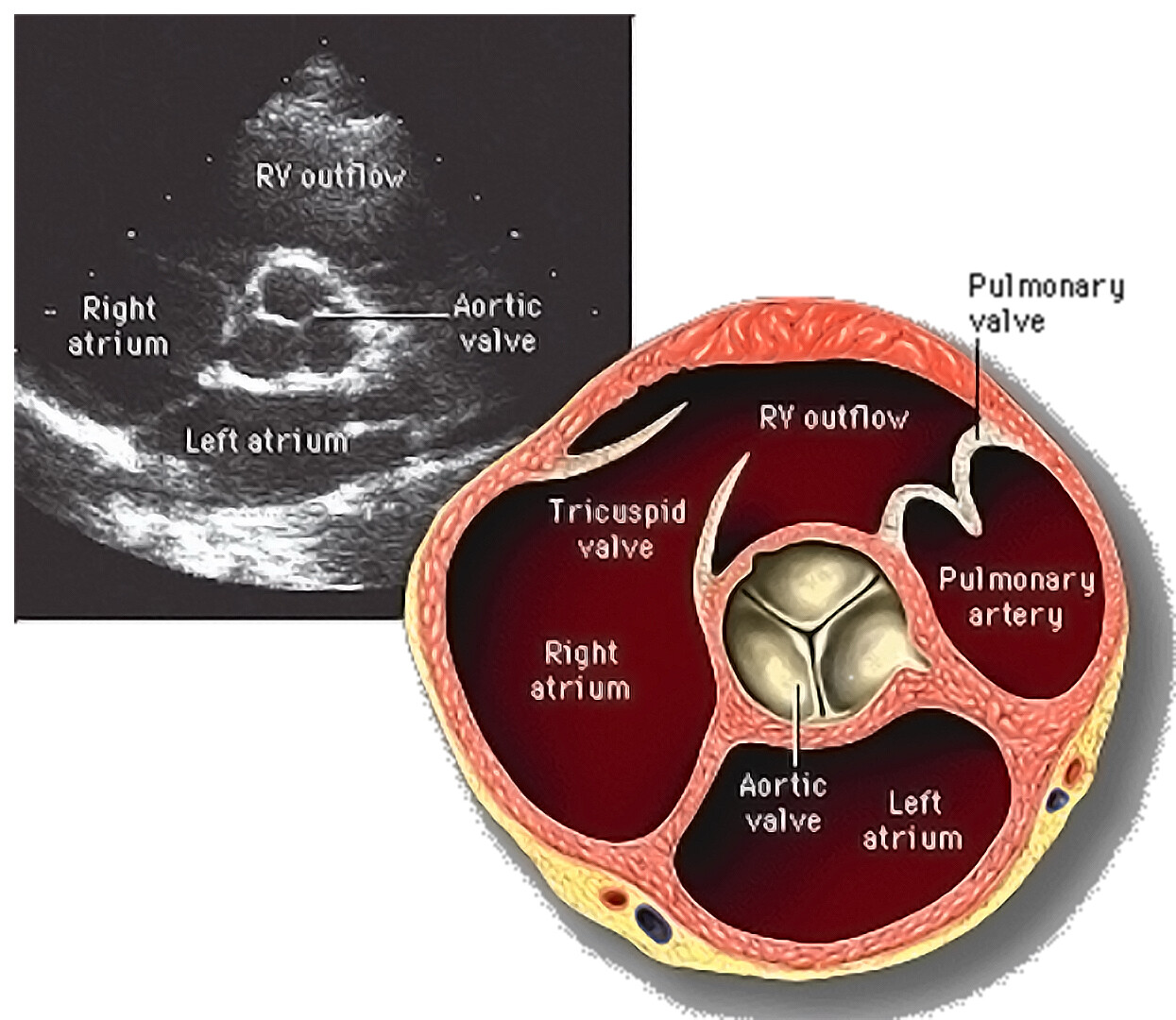 aortic-valve-storymd