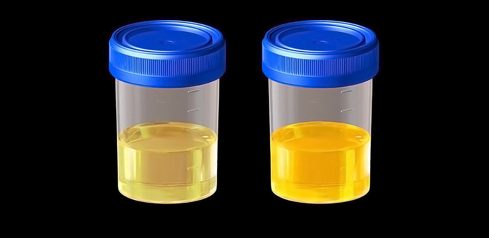 Bilirubin in Urine Test: Why Is It Done and What the Results Mean - StoryMD