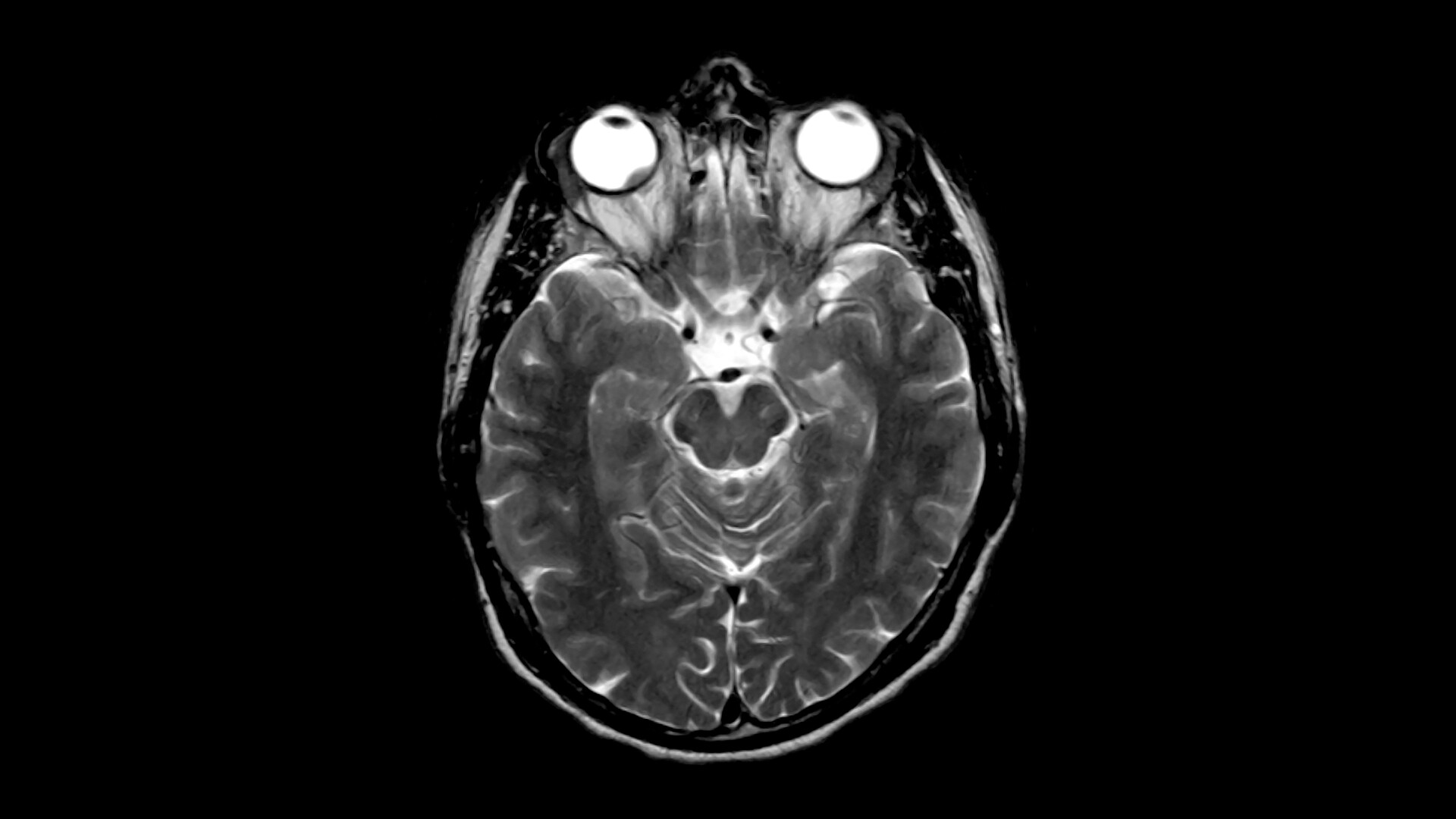 overview-of-intraocular-melanoma-storymd