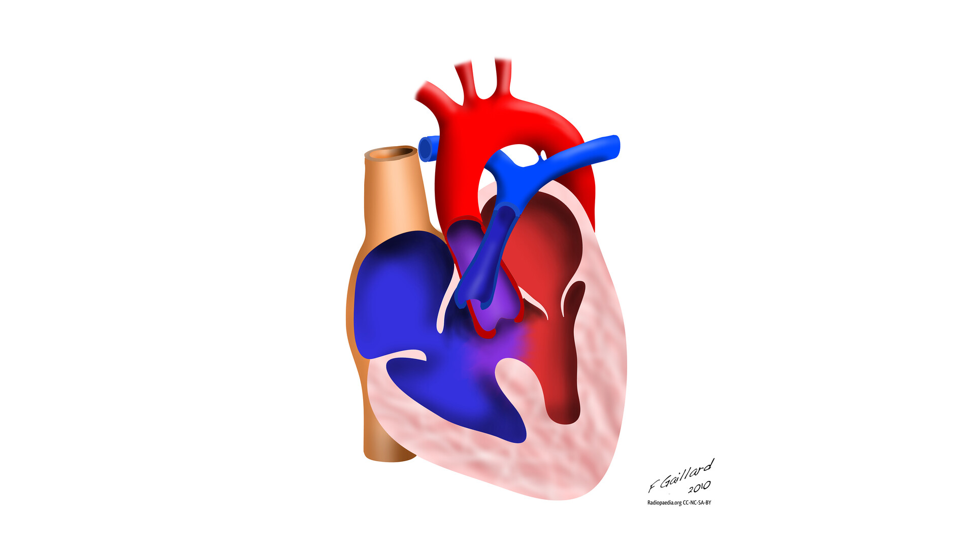 Tetralogy of Fallot (TOF): Causes, Diagnosis, Treatment - StoryMD