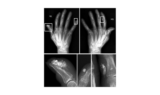 What Is CREST Syndrome?