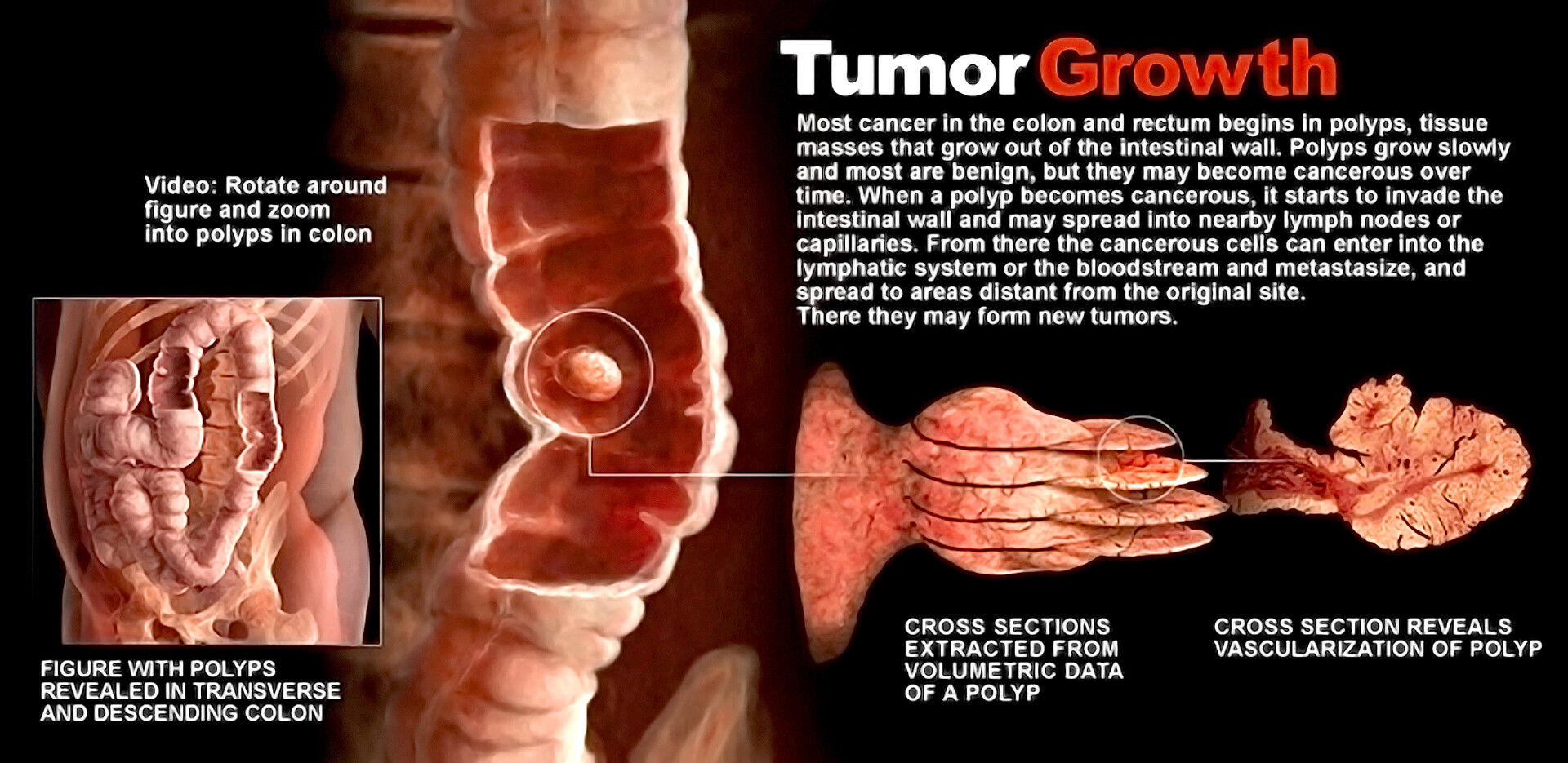 what-is-colon-cancer-storymd