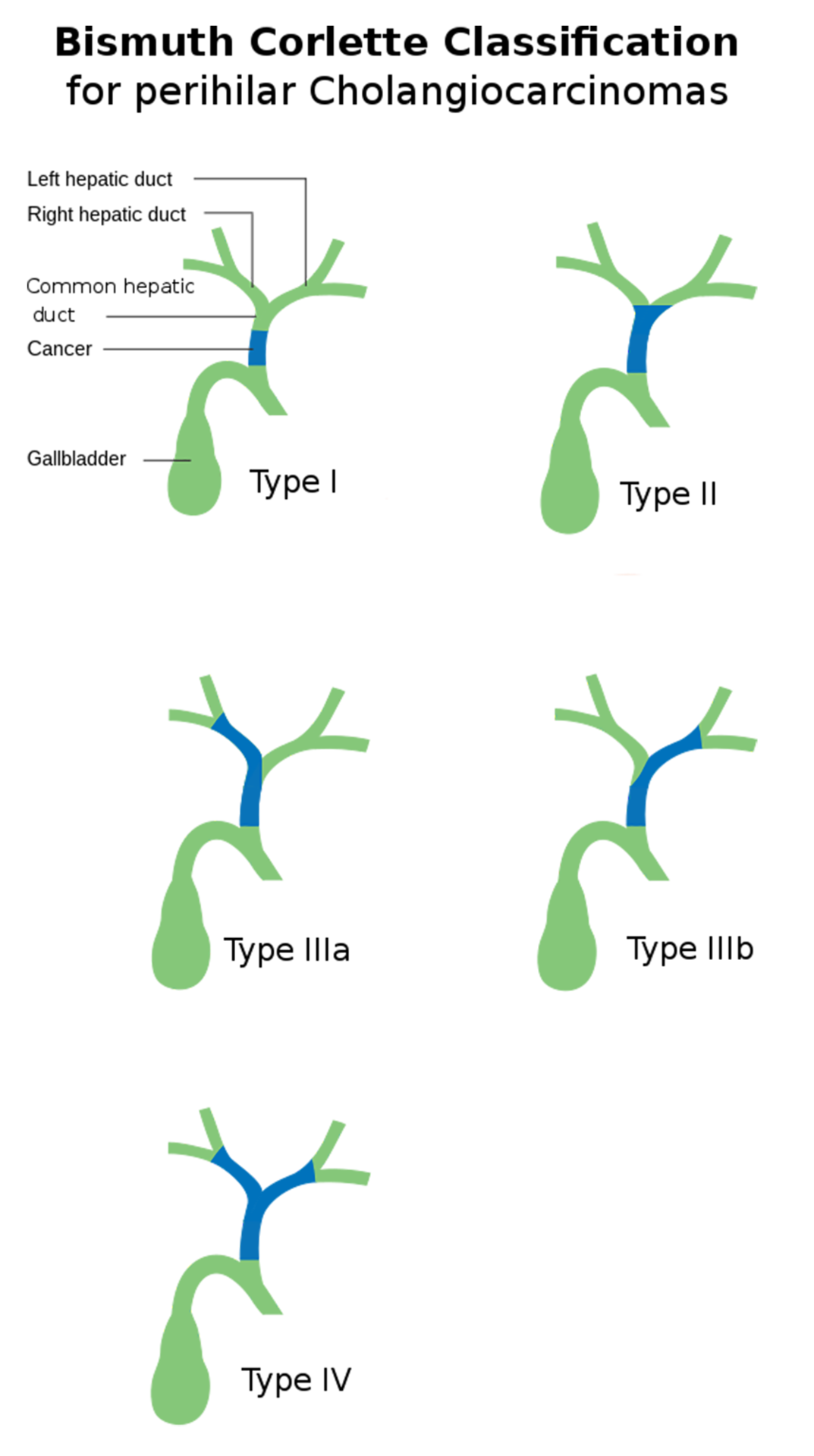 cholangiocarcinoma-type