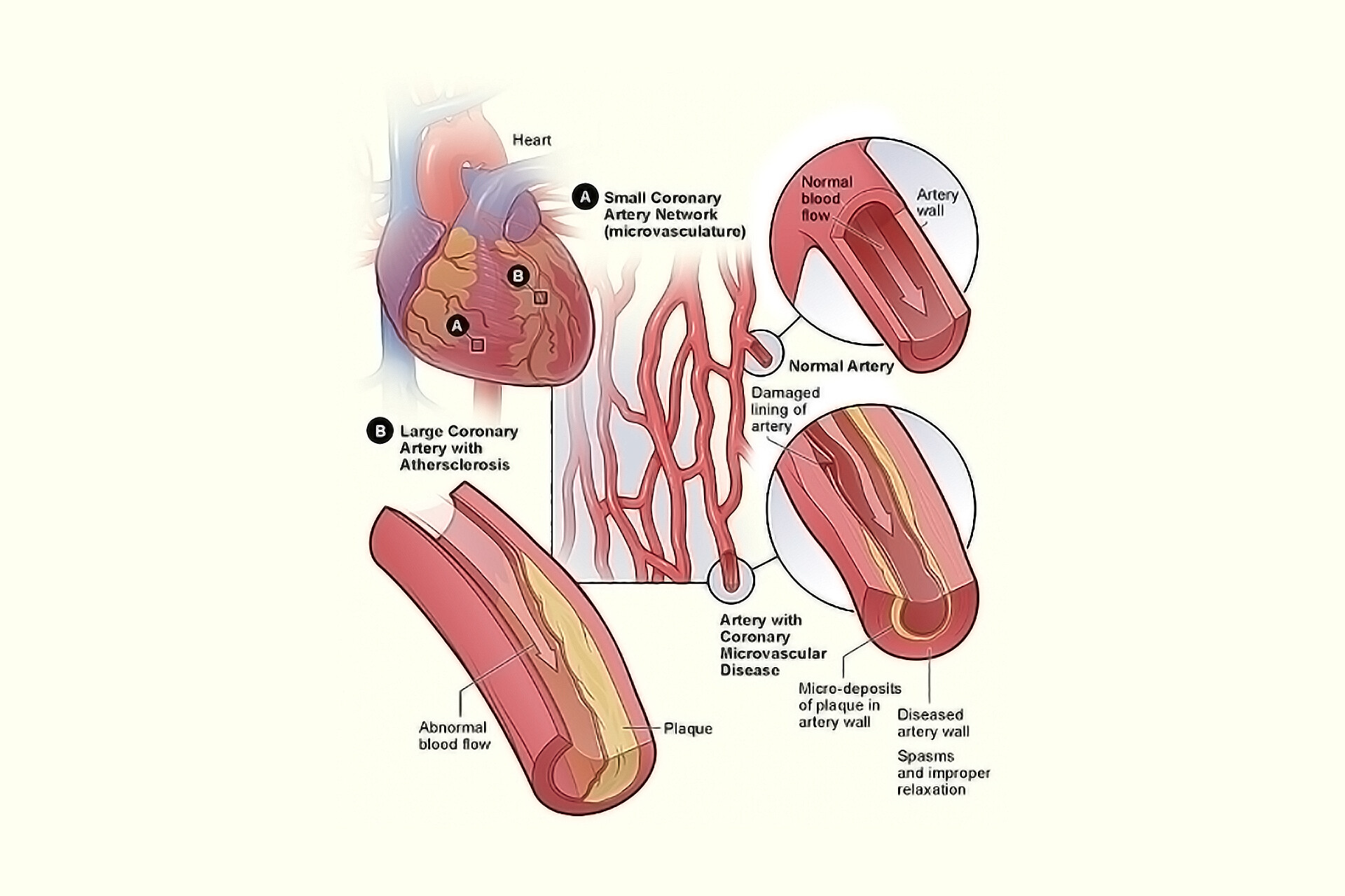 Coronary Microvascular Heart Disease
