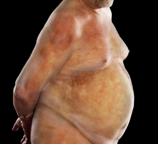 Weight Loss - Obese