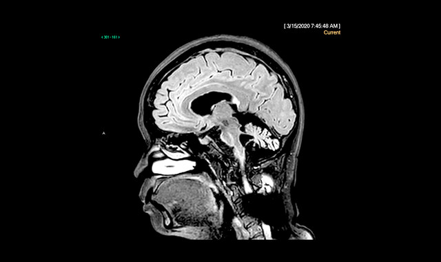 Cerebellar Degeneration - StoryMD