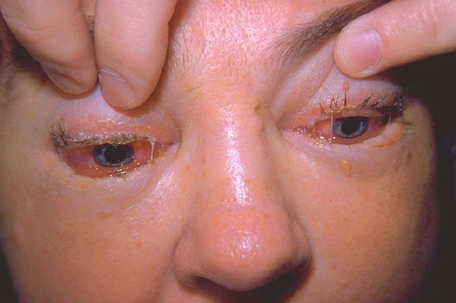 trichinosis in the eye