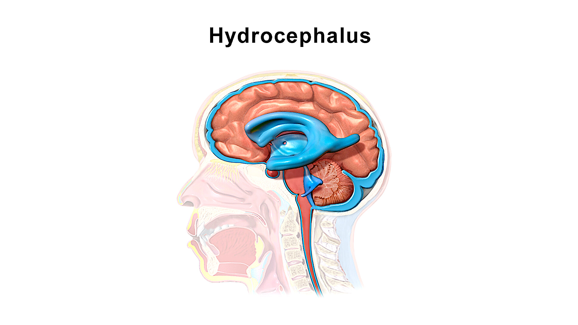 Hydrocephalus Due To Congenital Stenosis Of Aqueduct Of Sylvius Storymd 4074