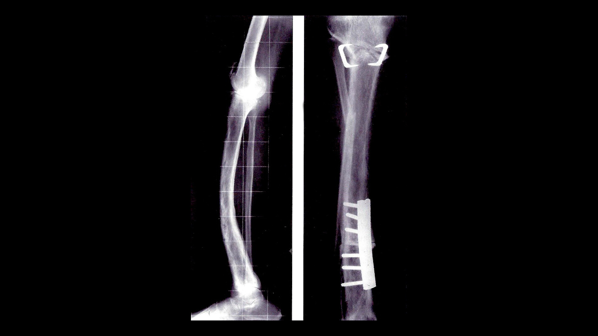 Juvenile Paget Disease StoryMD