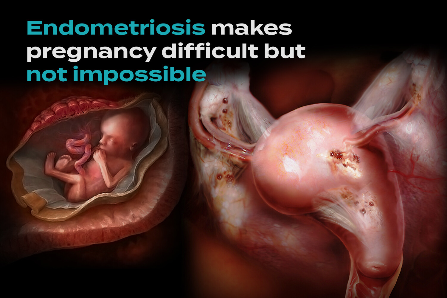 Endometriosis happens when tissue similar to the lining of the