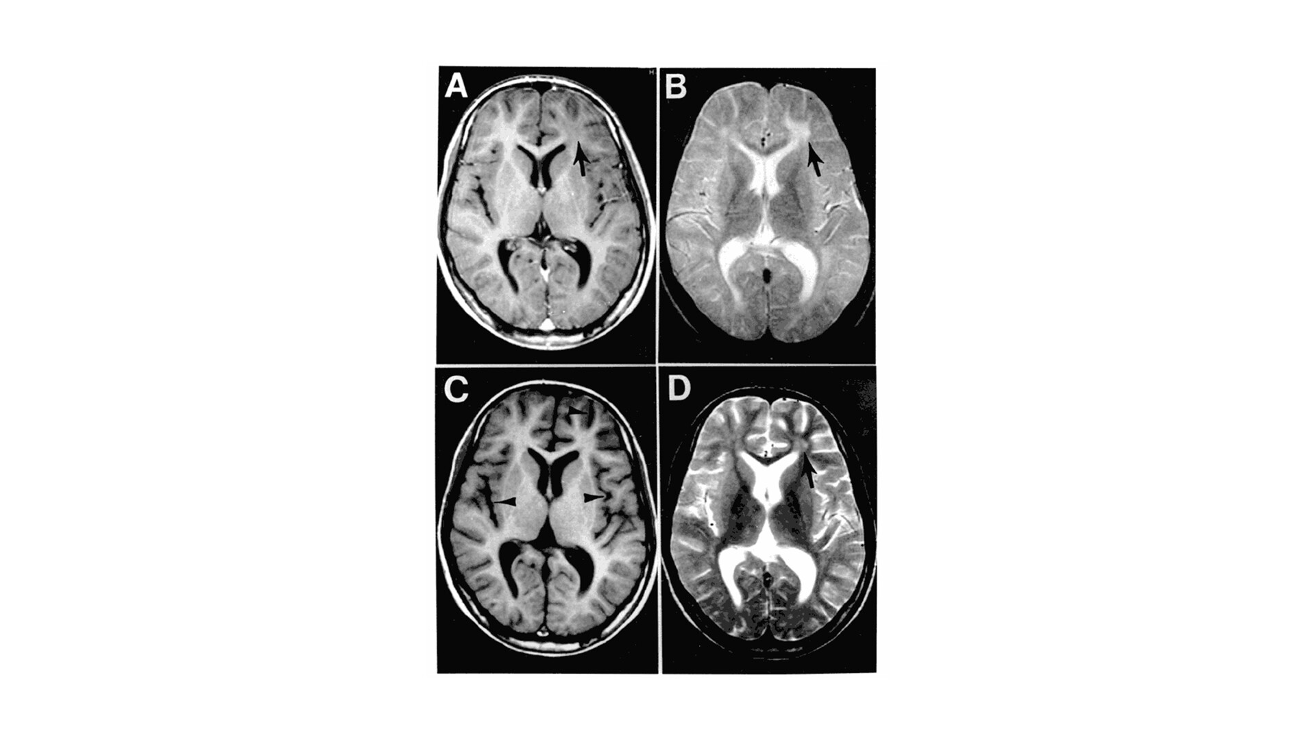 Subacute Sclerosing Panencephalitis