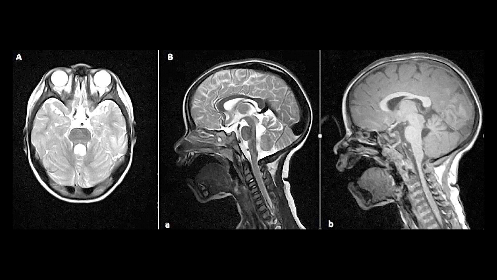 Joubert Syndrome - StoryMD
