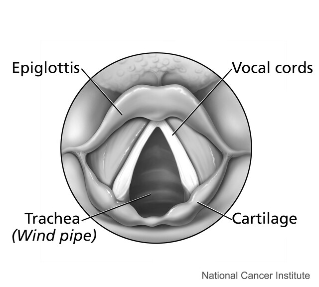 Laryngomalacia Diagram