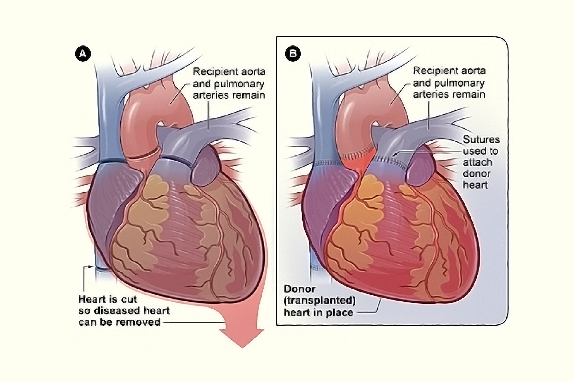 Heart Transplantation - StoryMD