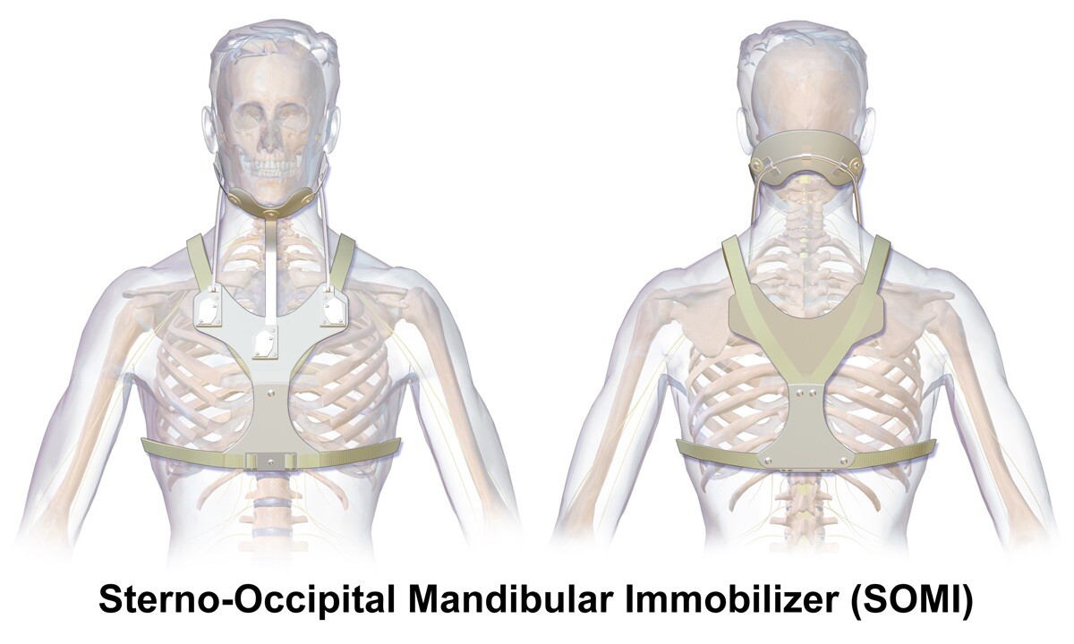 Hangman's Fracture C2 - 3D model by tl0615 (@tl0615) [d2df68e], image size:1200x720