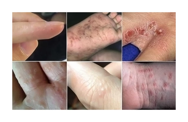 What is scabies and how do you get it?