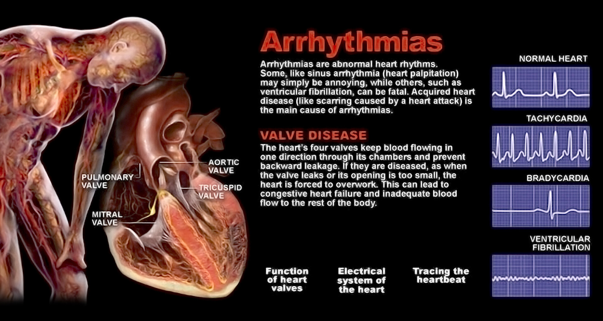 What Are the Types of Arrhythmias? - StoryMD