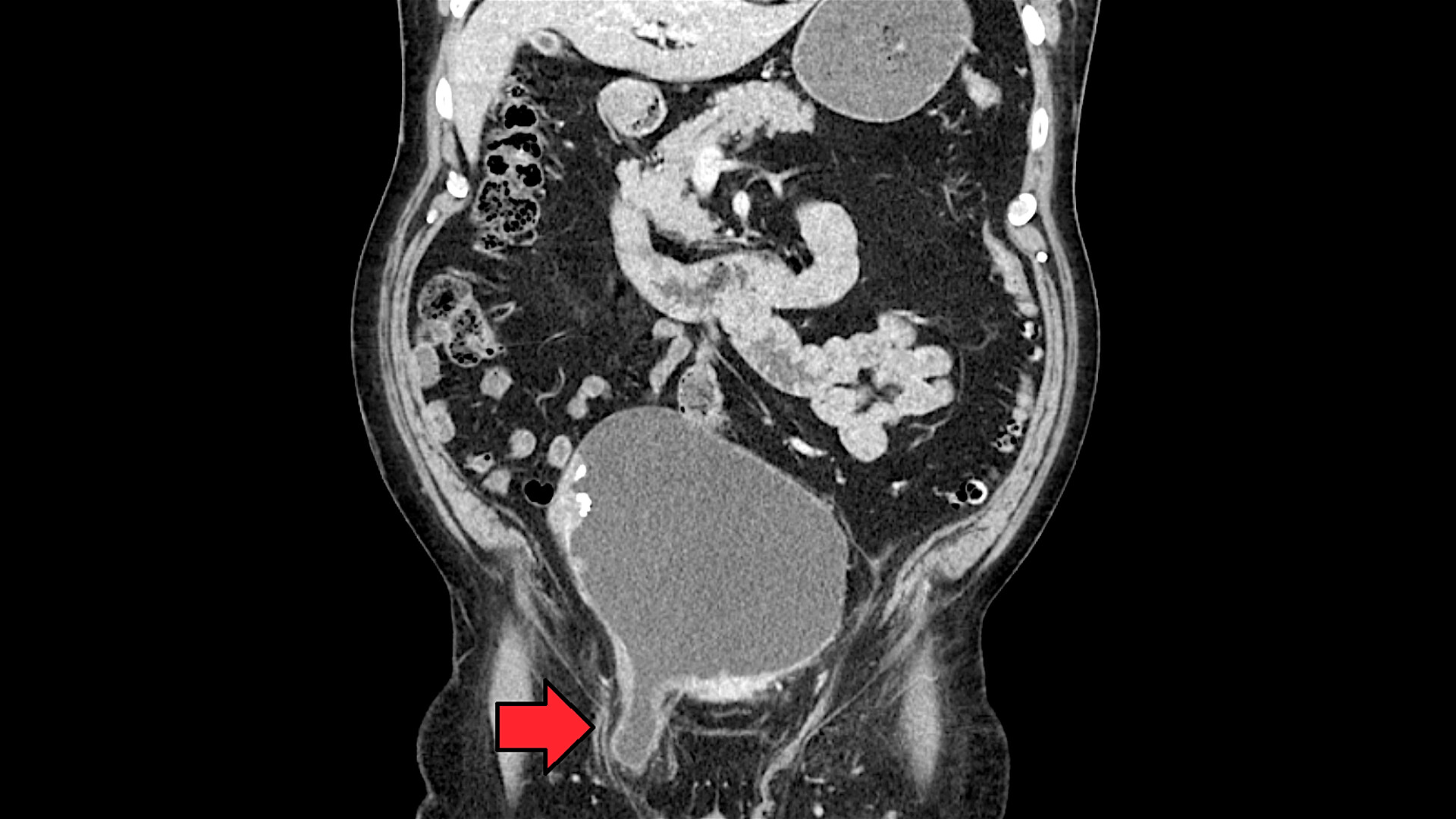 Inguinal Hernia (Groin Hernia): Causes, Symptoms, Treatment - StoryMD