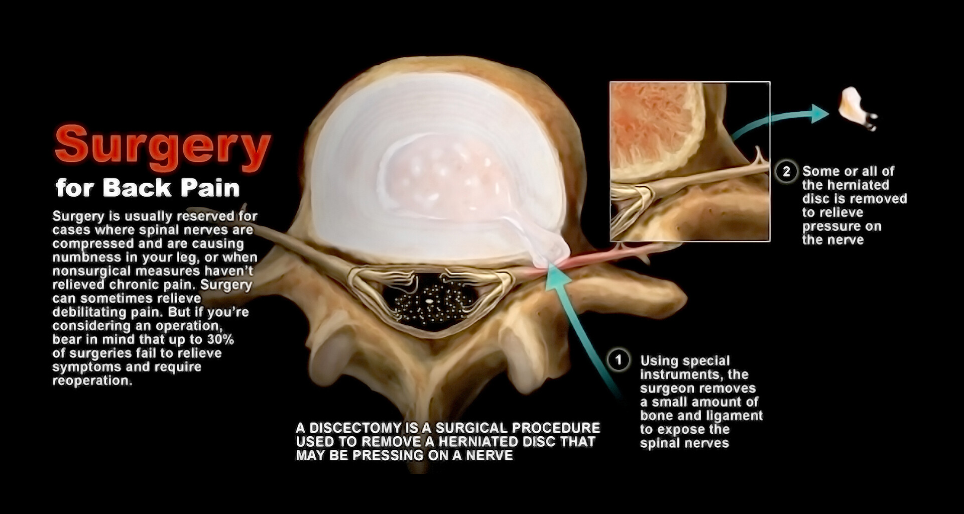 Surgery for a Slipped Disc - StoryMD