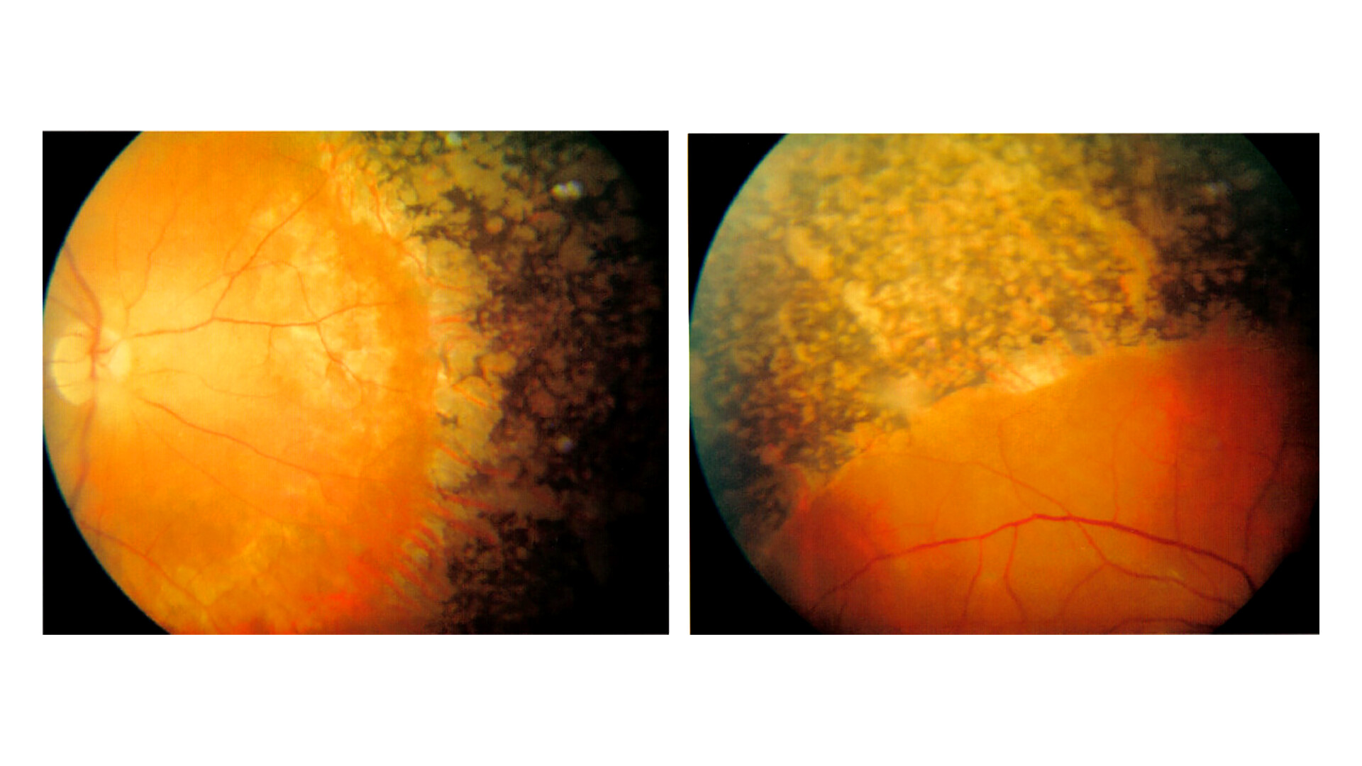 Distorted Rp Vision How Does Retinitis Pigmentosa Affect Vision